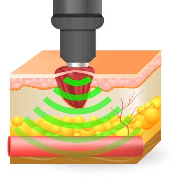 the Acoustic waves induce microtrauma in damaged tissues